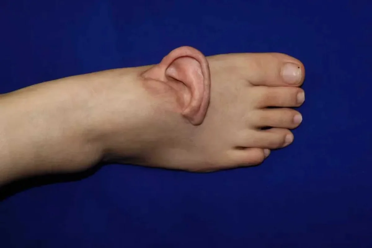Scientists Successfully Graft Human Ear Onto Patient’s Foot in Unprecedented Medical Breakthrough