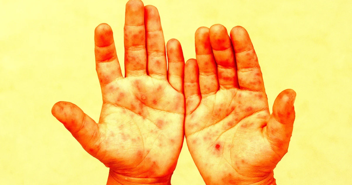 The CDC Is Now Denying That Specific Children Died From Measles, in a Scandal Potentially Beyond Anything in Its History